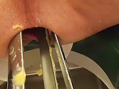 Задницы огромные speculum, двойной Фистинг, насос